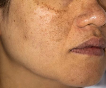 How to Treat Hyperpigmentation Naturally with Home Remedies