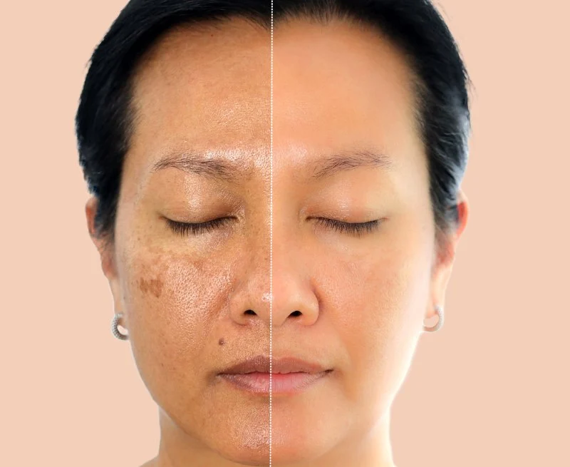 The Best Skin Care Treatments for Hyperpigmentation and Dark Spots