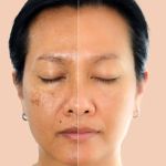 The Best Skin Care Treatments for Hyperpigmentation and Dark Spots
