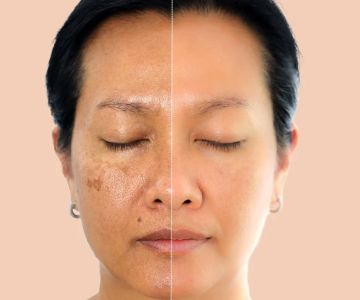 The Best Skin Care Treatments for Hyperpigmentation and Dark Spots