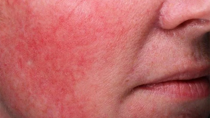 How to Get Rid of Skin Redness and Inflammation with the Right Skincare