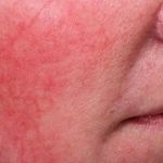 How to Get Rid of Skin Redness and Inflammation with the Right Skincare