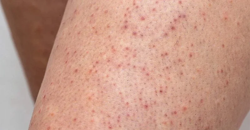 How to Treat Skin Bumps and Keratosis Pilaris with Effective Skin Care