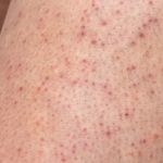 How to Treat Skin Bumps and Keratosis Pilaris with Effective Skin Care
