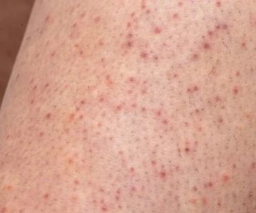 How to Treat Skin Bumps and Keratosis Pilaris with Effective Skin Care