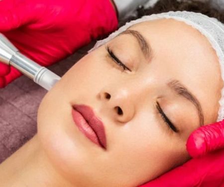 What Is Microneedling and How Can It Improve Your Skin?