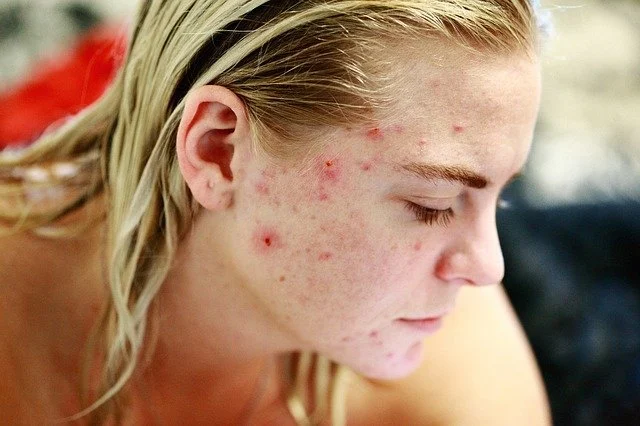 How to Prevent Skin Breakouts During Stressful Times