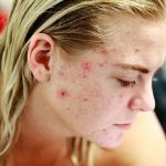 How to Prevent Skin Breakouts During Stressful Times
