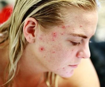 How to Prevent Skin Breakouts During Stressful Times