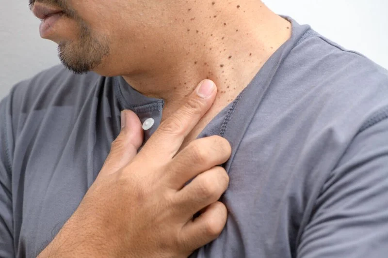 How to Treat Skin Tags with Professional and At-Home Remedies Safely