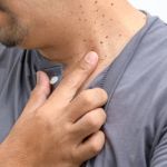 How to Treat Skin Tags with Professional and At-Home Remedies Safely