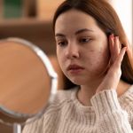 Effective Ways to Treat and Prevent Skin Pigmentation from Hormonal Changes