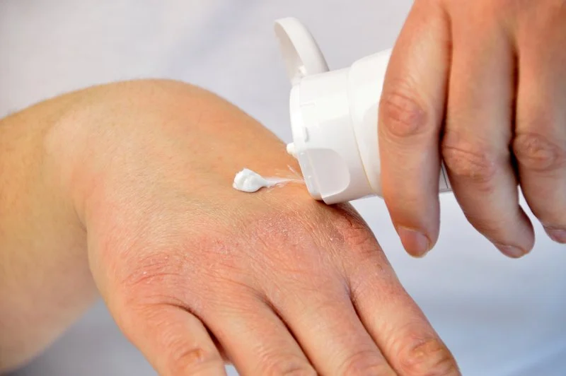 Effective Ways to Prevent Skin Dryness During Winter with Hydrating Creams