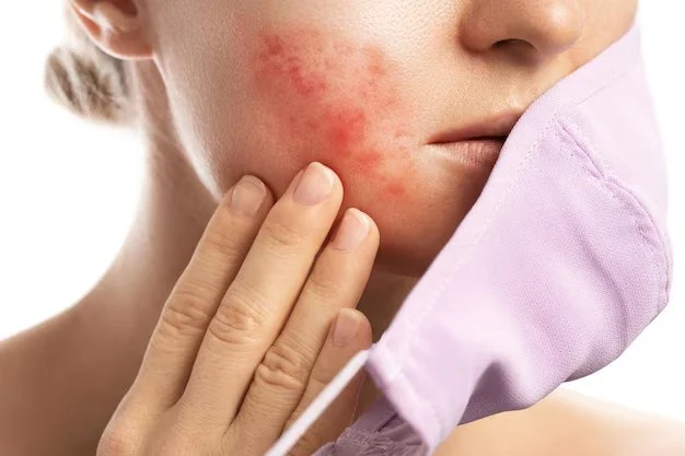 How to Treat and Prevent Skin Breakouts from Wearing Masks | SkinCare Experts