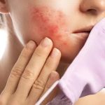 How to Treat and Prevent Skin Breakouts from Wearing Masks | SkinCare Experts