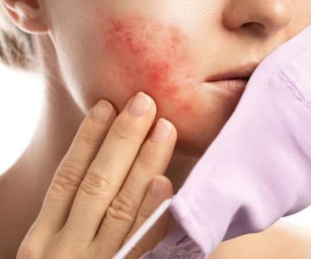 How to Treat and Prevent Skin Breakouts from Wearing Masks | SkinCare Experts
