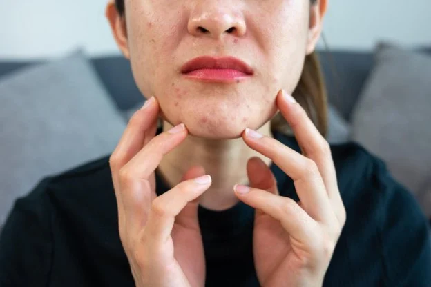 How to Prevent and Treat Sensitive Skin Breakouts Effectively