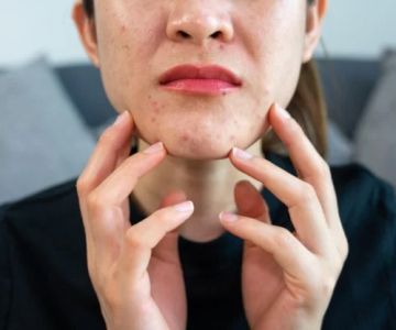 How to Prevent and Treat Sensitive Skin Breakouts Effectively