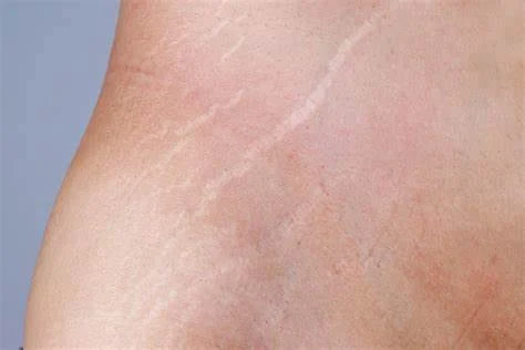 How to Treat and Prevent Skin Stretch Marks Using Natural Solutions