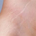 How to Treat and Prevent Skin Stretch Marks Using Natural Solutions