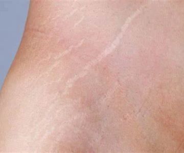 How to Treat and Prevent Skin Stretch Marks Using Natural Solutions
