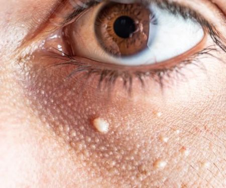 How to Get Rid of Milia and Prevent Future Breakouts for Healthy Skin