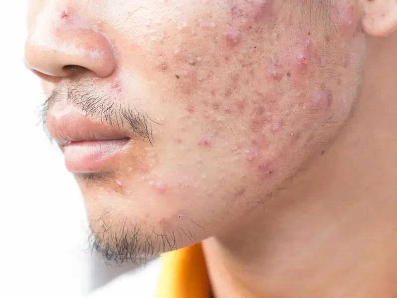 How to Treat Acne with Tea Tree Oil: What You Need to Know for Clear Skin