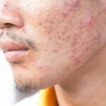 How to Treat Acne with Tea Tree Oil: What You Need to Know for Clear Skin