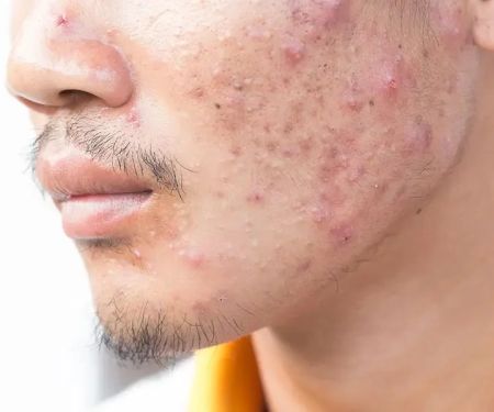 How to Treat Acne with Tea Tree Oil: What You Need to Know for Clear Skin