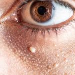 Effective Methods on How to Get Rid of Milia and Prevent Future Breakouts